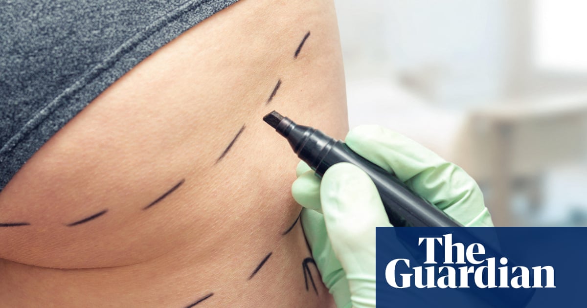 Brazilian butt lifts should be banned in UK amid ‘wild west’ industry, MPs say