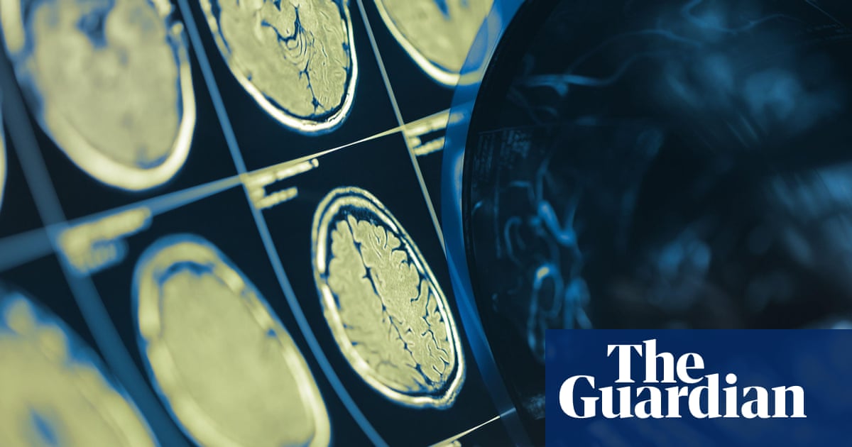 Lacunar strokes caused by widening of arteries in brain, study suggests