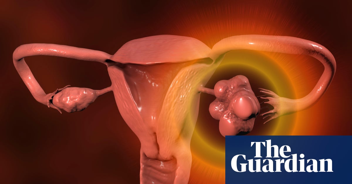 Women with irregular periods should be checked for PMOS, NHS says