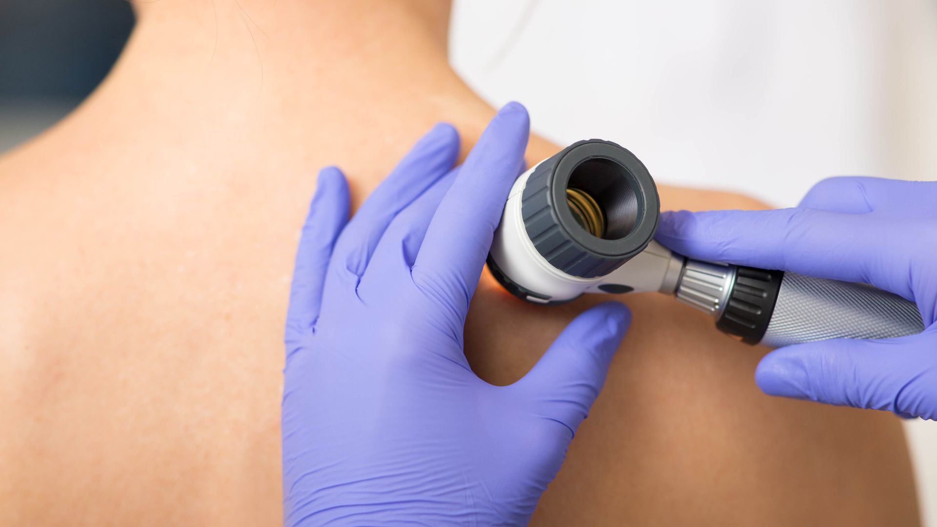 Skin cancer cases at record high in UK