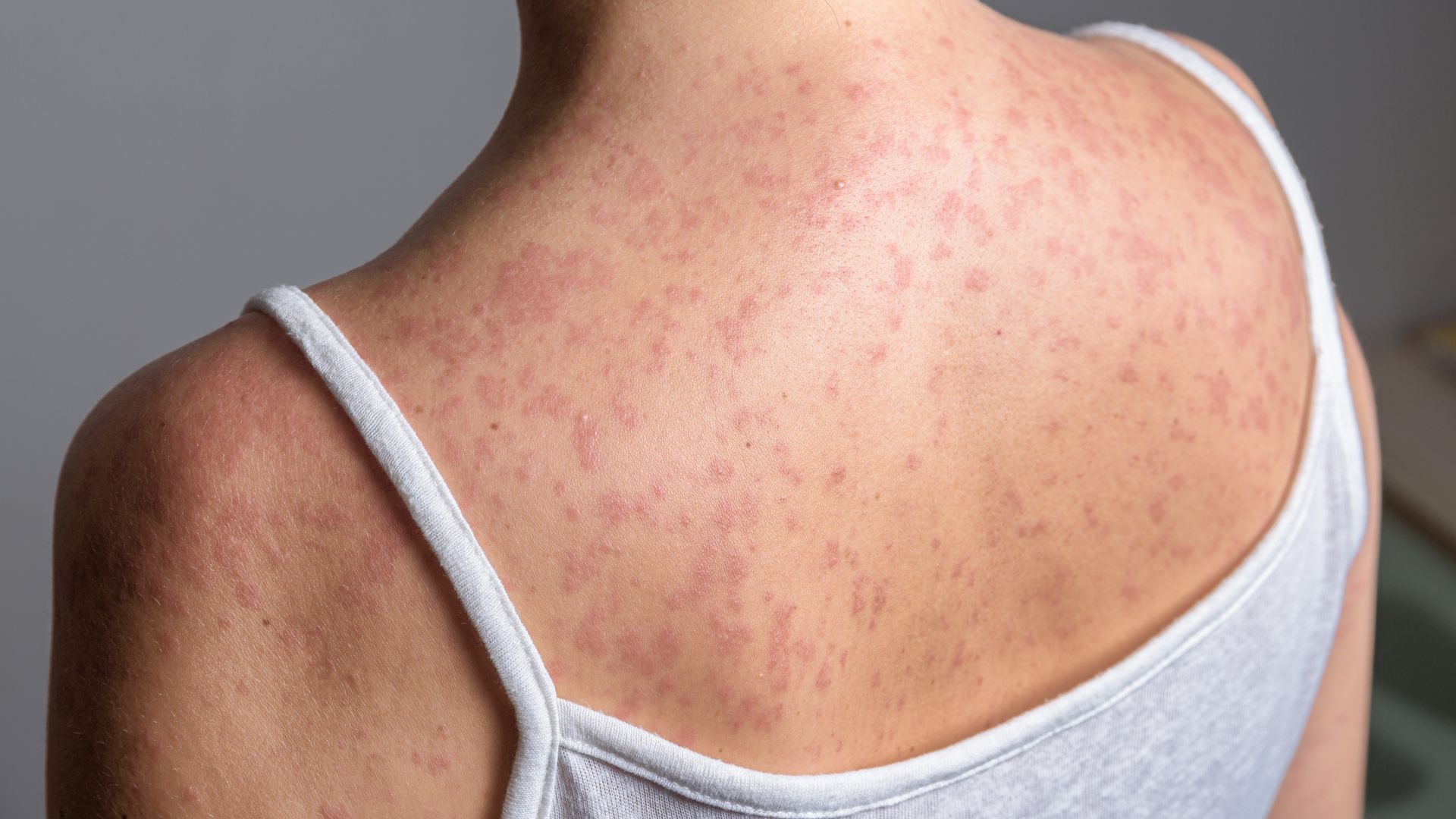 Measles cases continue to rise in England - and this is where outbreak could spread next