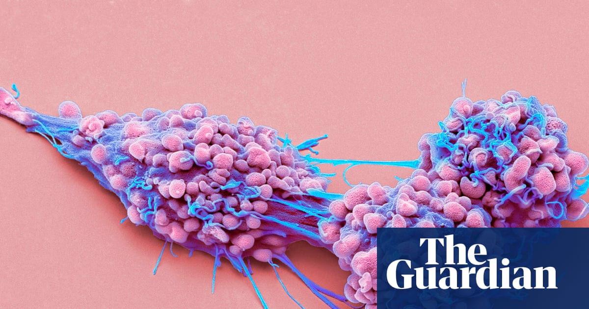 Life-prolonging drug for advanced ovarian cancer gets go-ahead in England