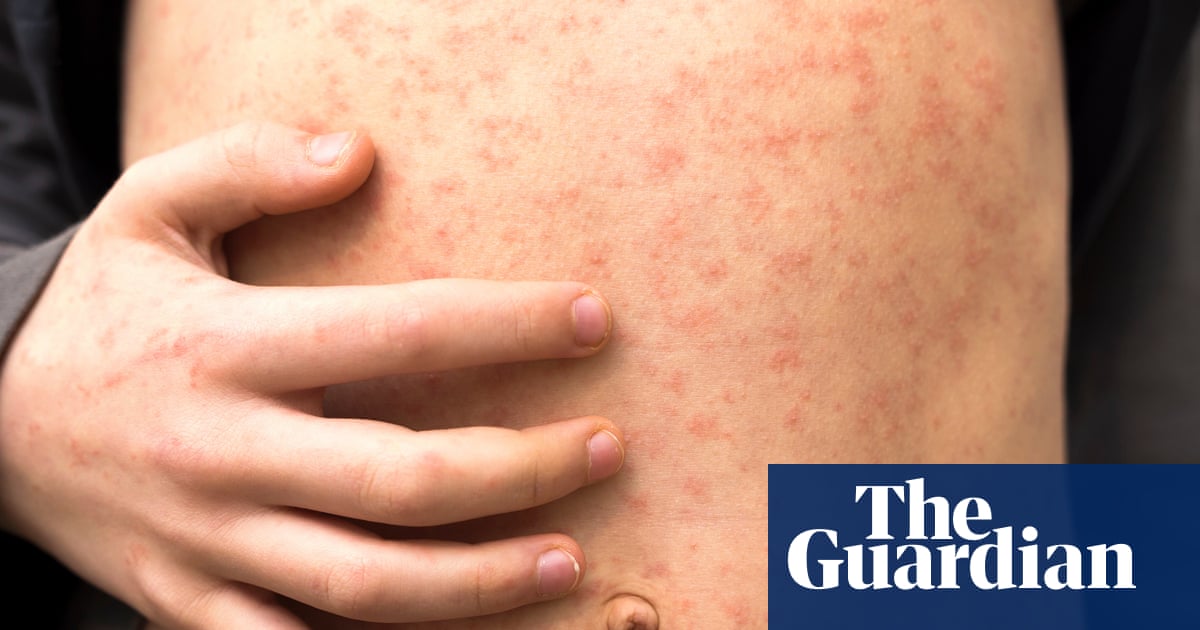 More than 60 children infected in north London measles outbreak