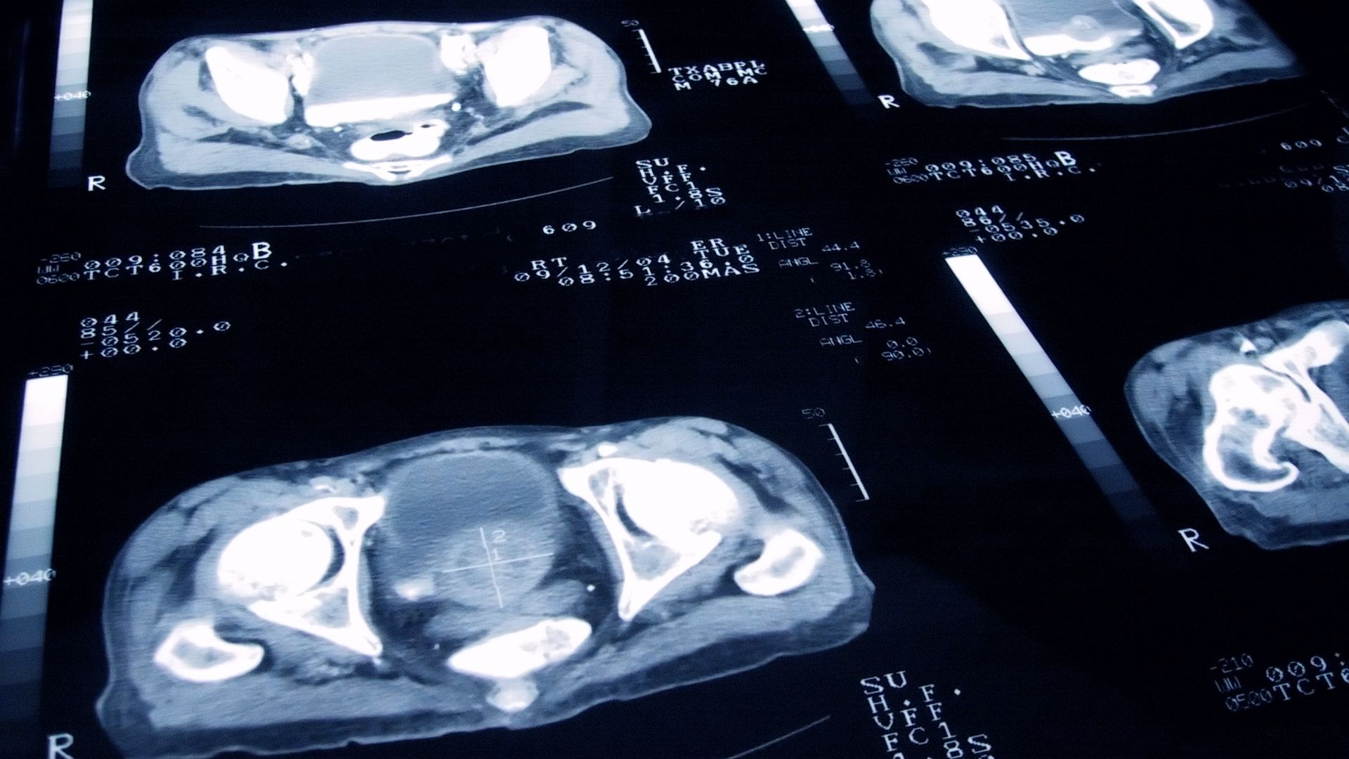 Cancer death rates fall to historic low - as types with biggest drop in fatalities revealed