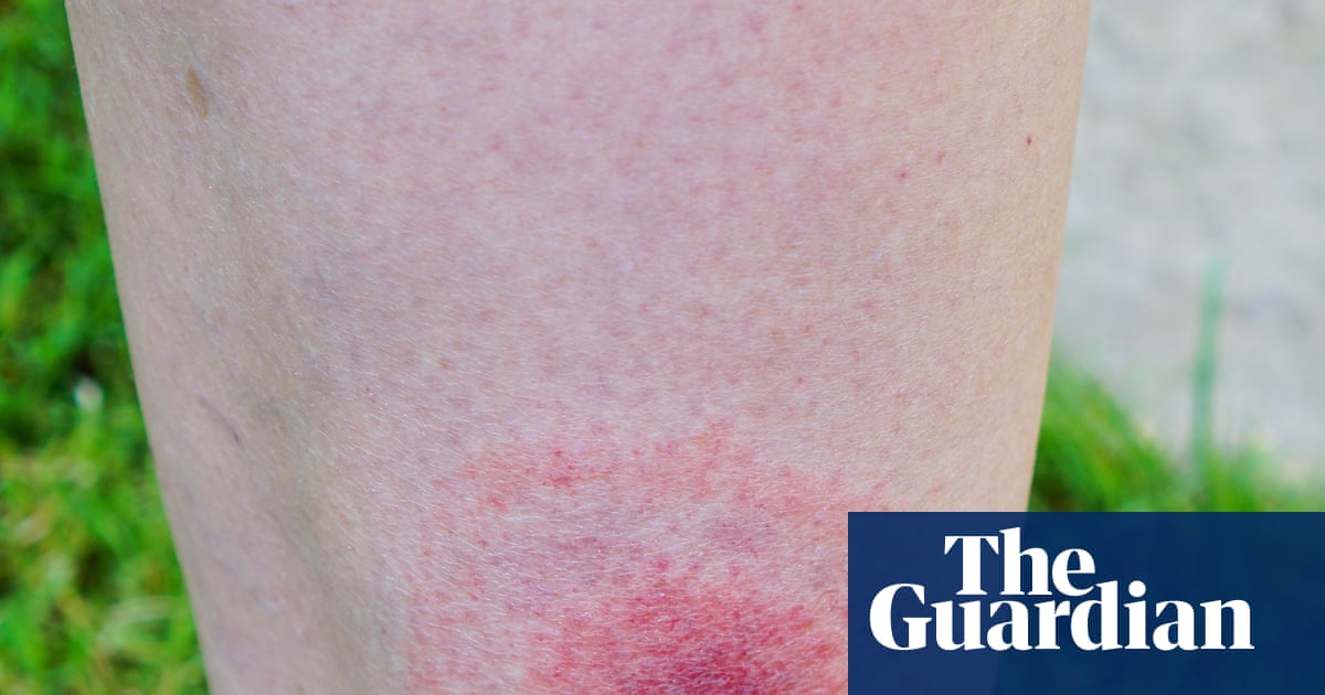 Lyme disease cases in England rise by more than 20% in a year