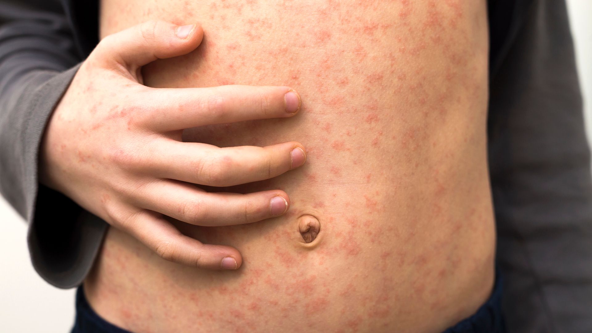 'Fast-spreading' measles outbreak in London leaves dozens of children infected